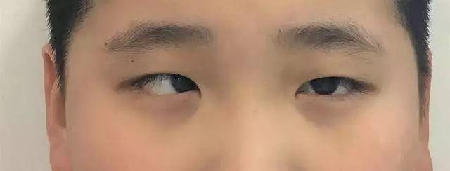 5岁女童沉迷手机,双眼斗鸡眼变形!医生提醒,警惕这种视力杀手