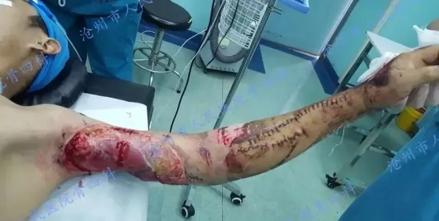缝合身首离断,在断裂处重寻完整的人